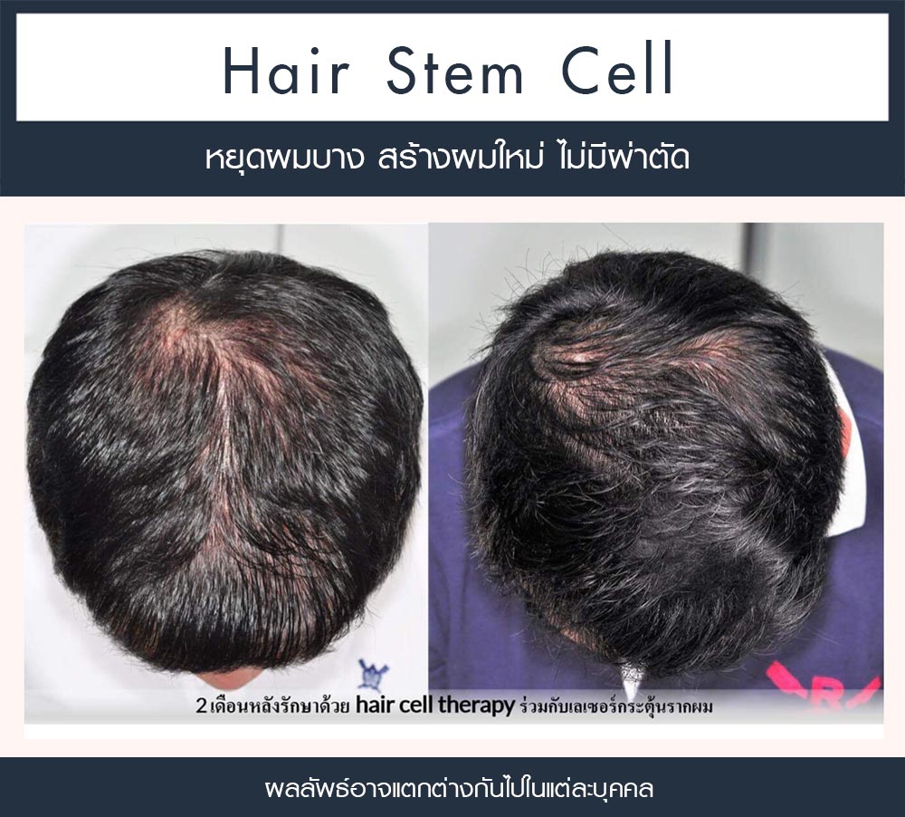 รีวิว Regenera Activa-ปลูกผมไม่ต้องผ่าตัด