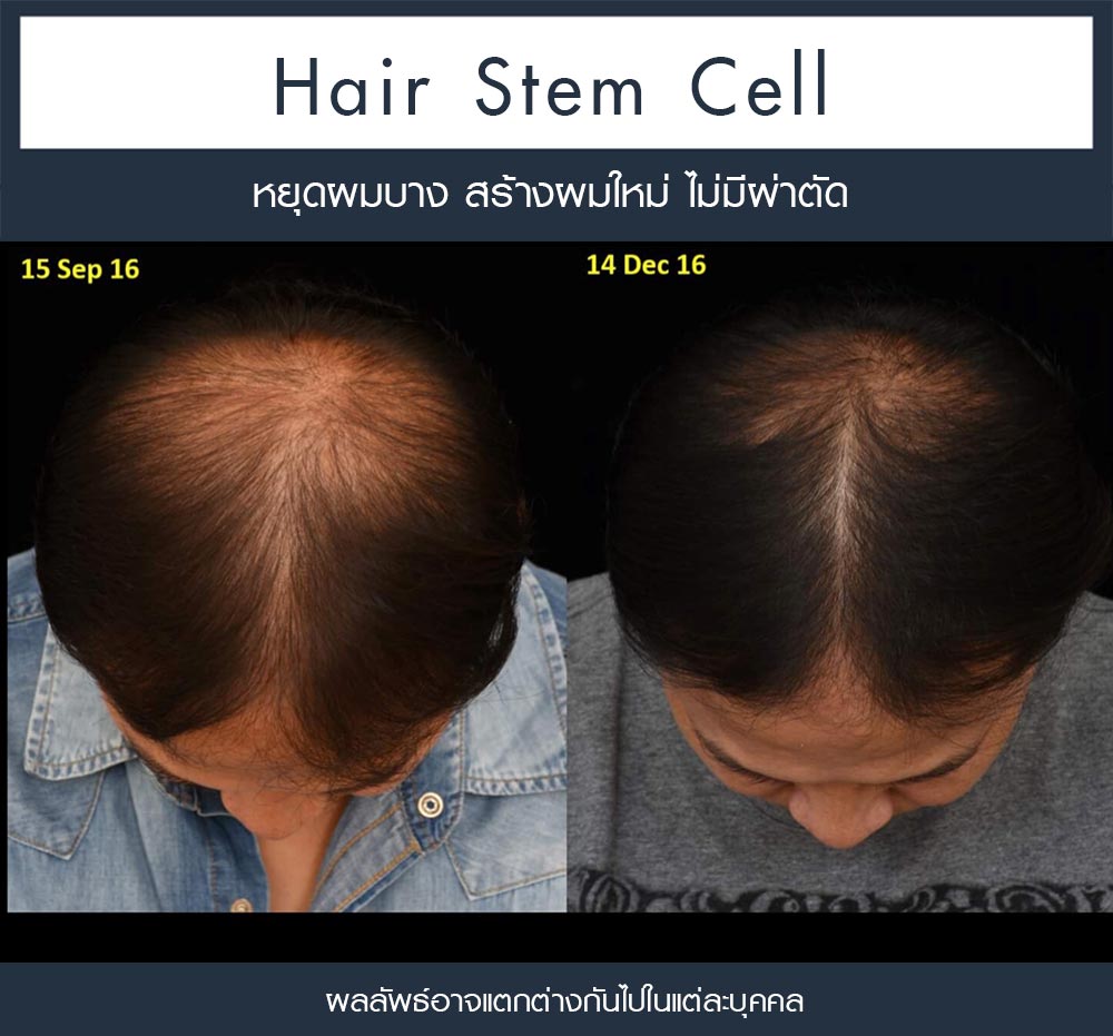 รีวิว Regenera Activa-ปลูกผมไม่ต้องผ่าตัด