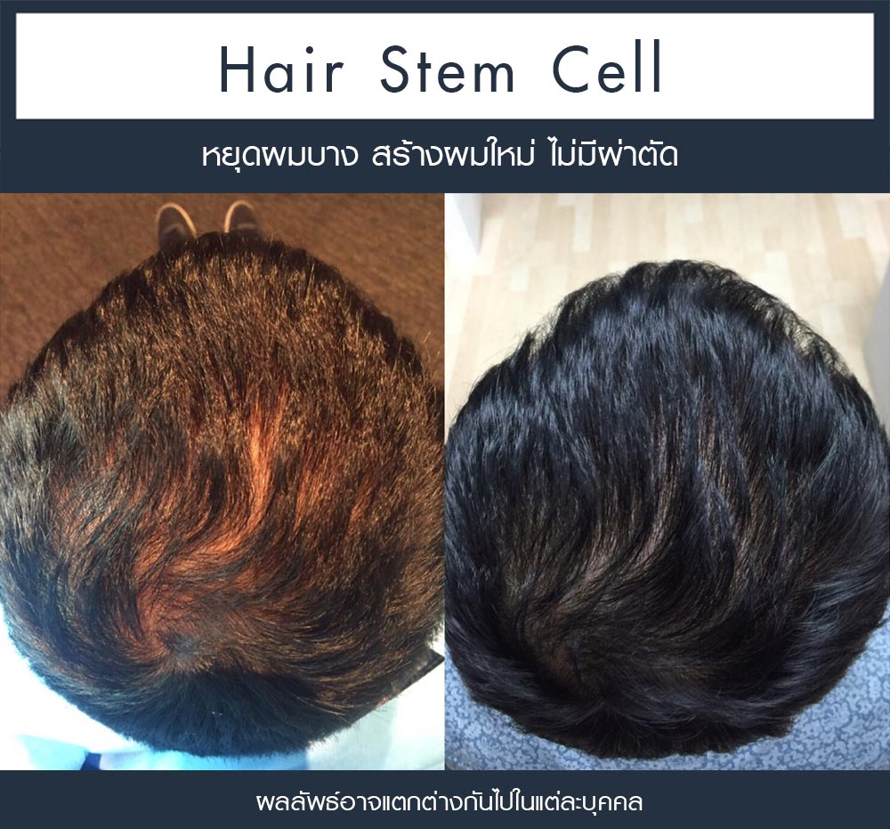 รีวิว Regenera Activa-ปลูกผมไม่ต้องผ่าตัด