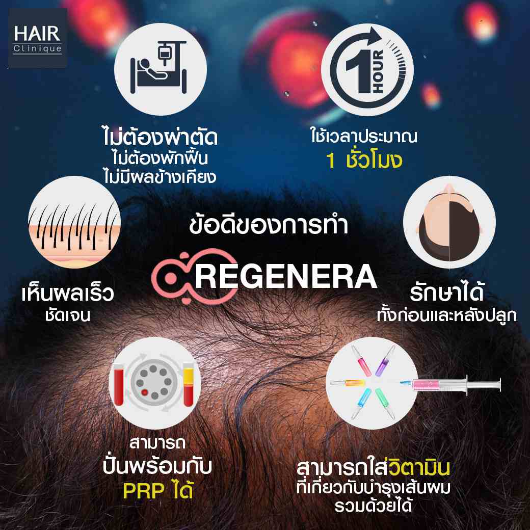 ข้อดีRegenera Activa-ปลูกผมไม่ต้องผ่าตัด