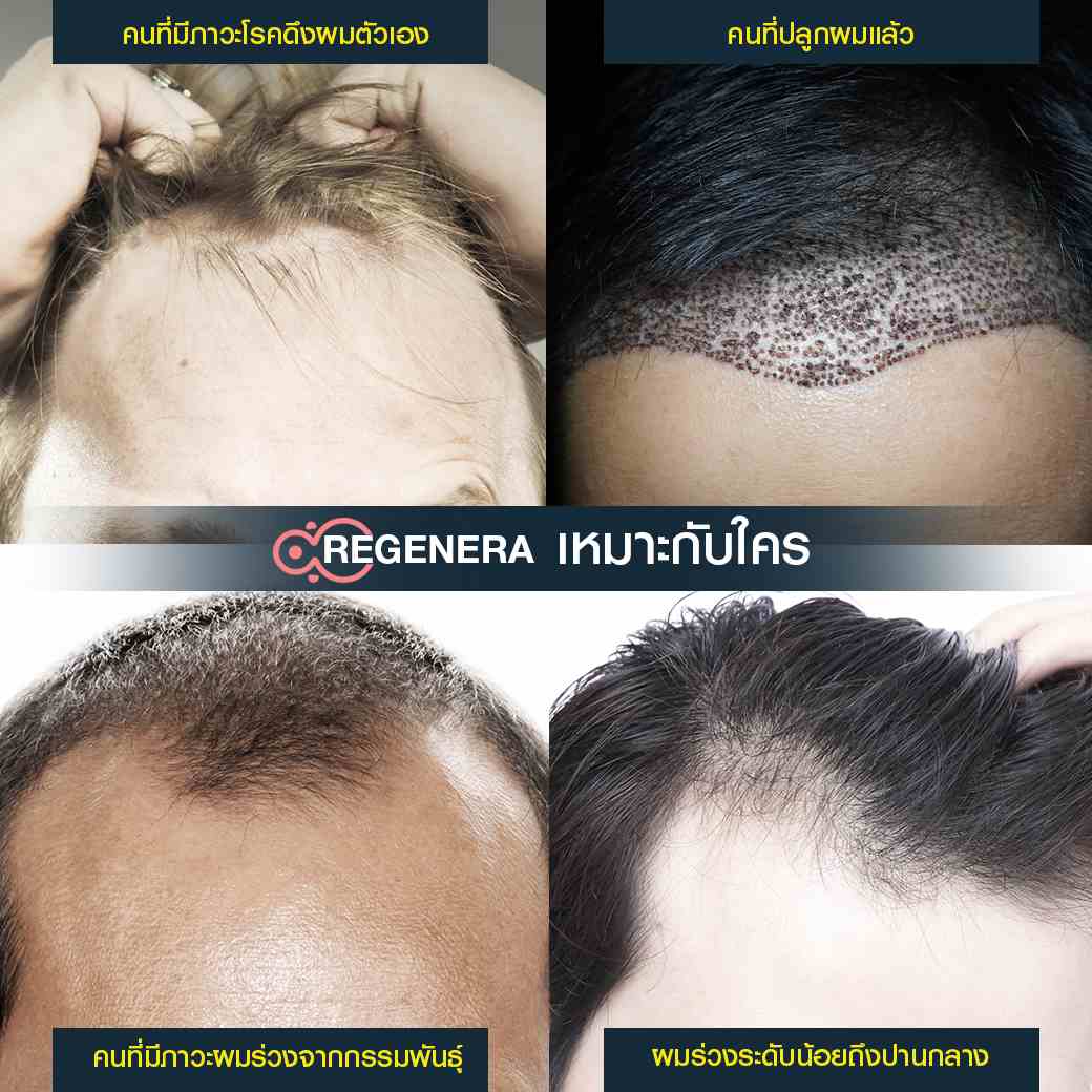 Regenera Activa-ปลูกผมไม่ต้องผ่าตัด เหมาะกับใคร