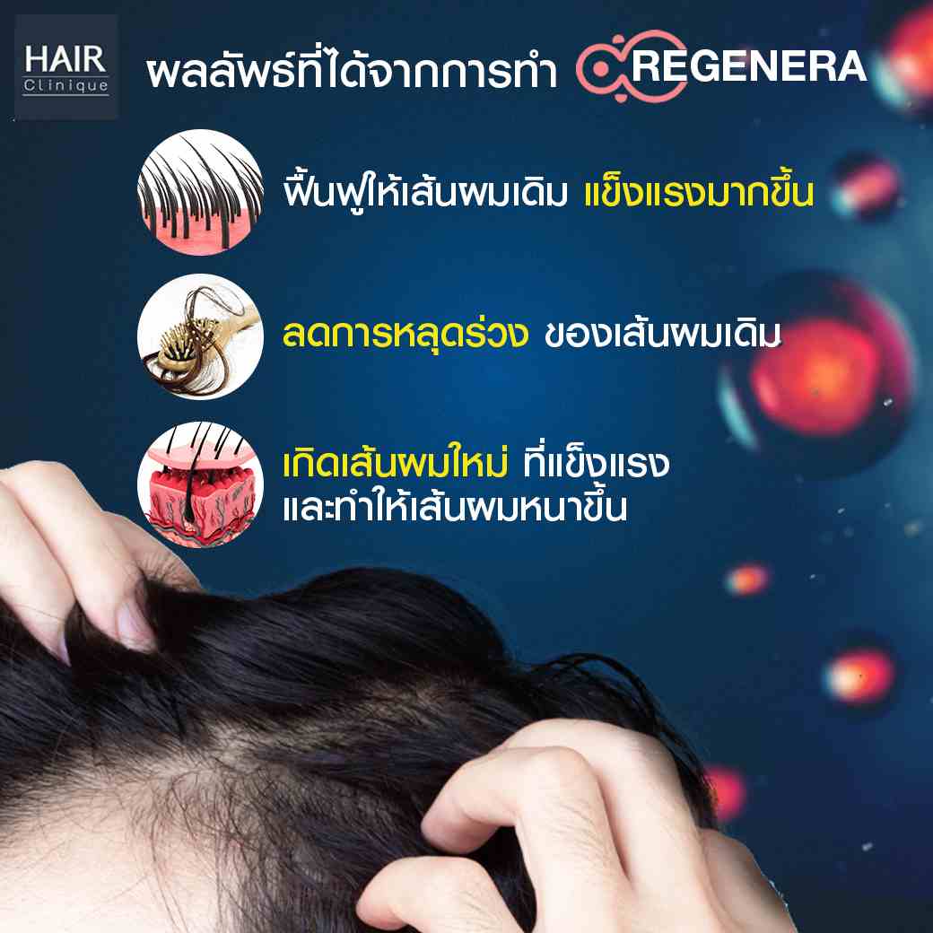 ผลลัพธ์การทำRegenera Activa-ปลูกผมไม่ต้องผ่าตัด