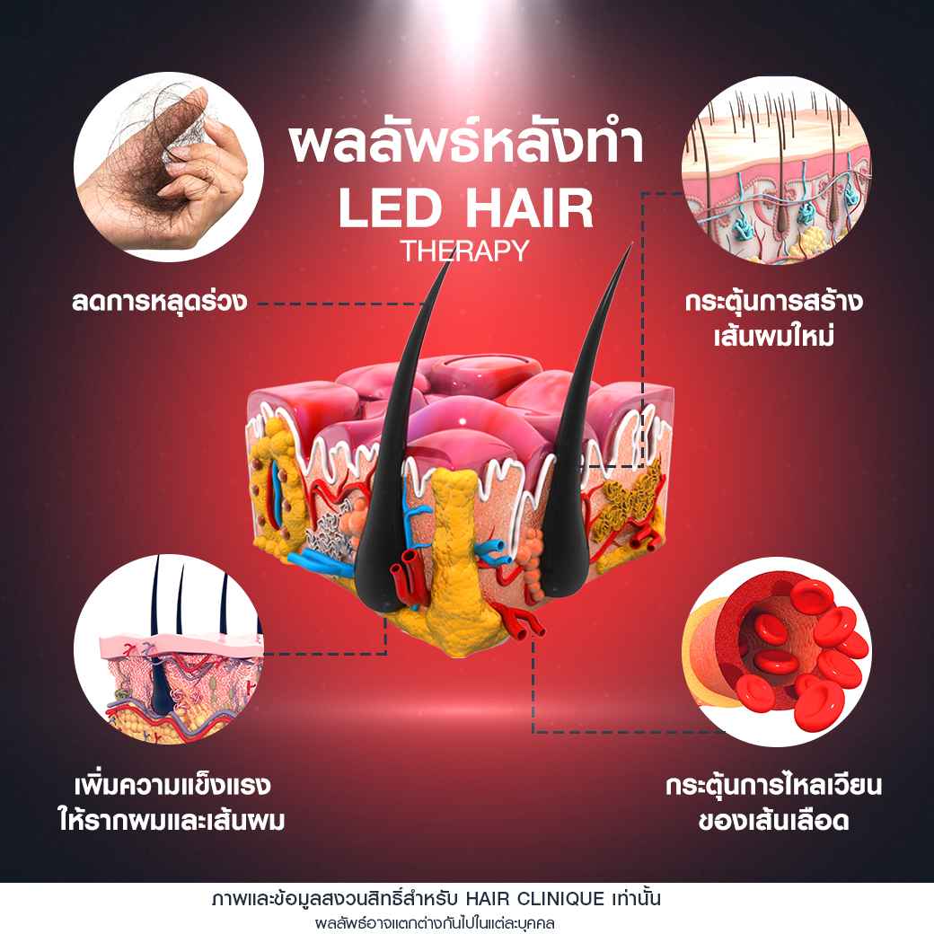 ผลลัพธ์LED Therapy,ฉายแสง led,แก้ผมบาง,แก้ผมบางกลางหัว,รักษาผมบาง,ฉายแสงลดผมร่วง,วิธีกระตุ้นรากผม