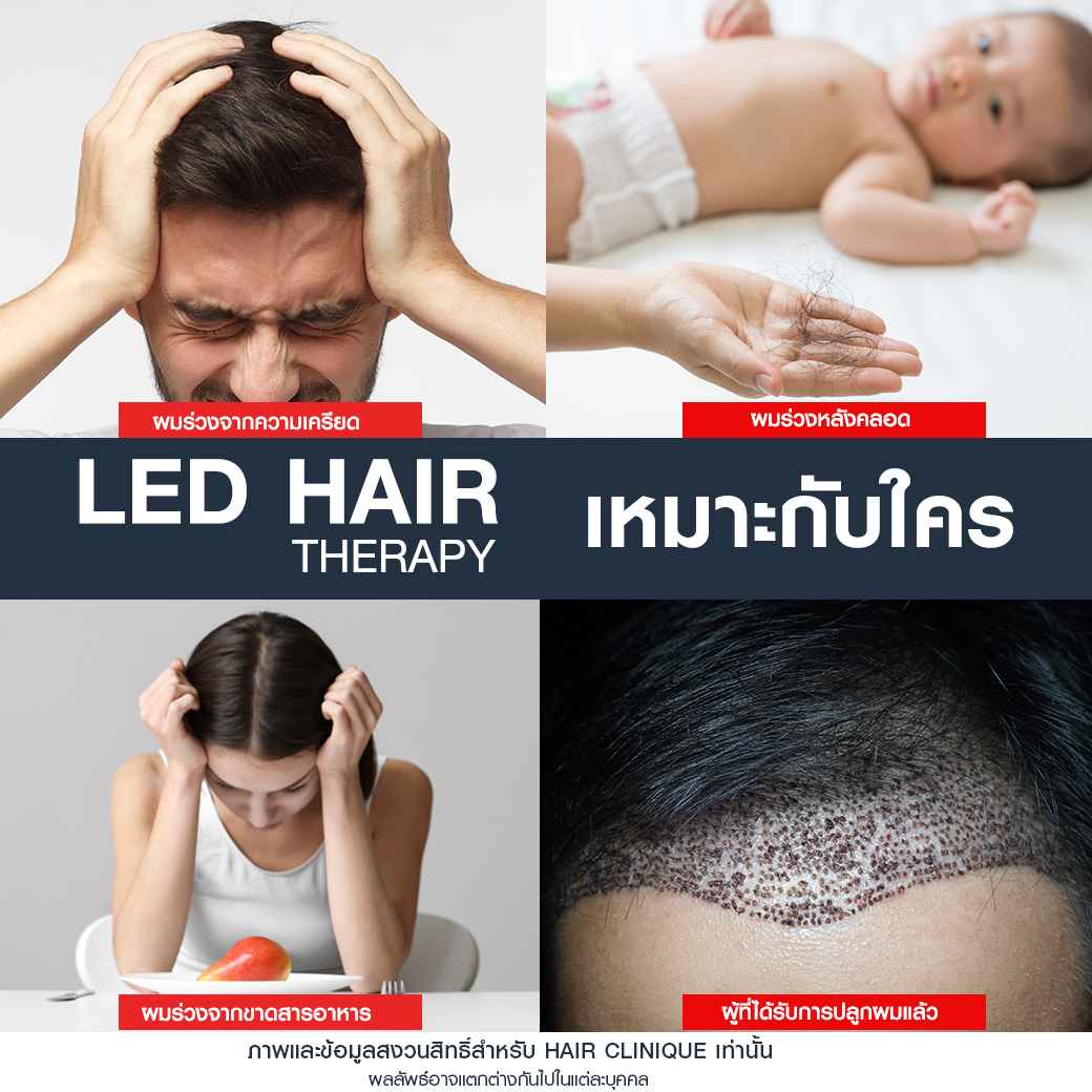 LED Therapyเหมาะกับใคร,ฉายแสง led,แก้ผมบาง,แก้ผมบางกลางหัว,รักษาผมบาง,ฉายแสงลดผมร่วง,วิธีกระตุ้นรากผม