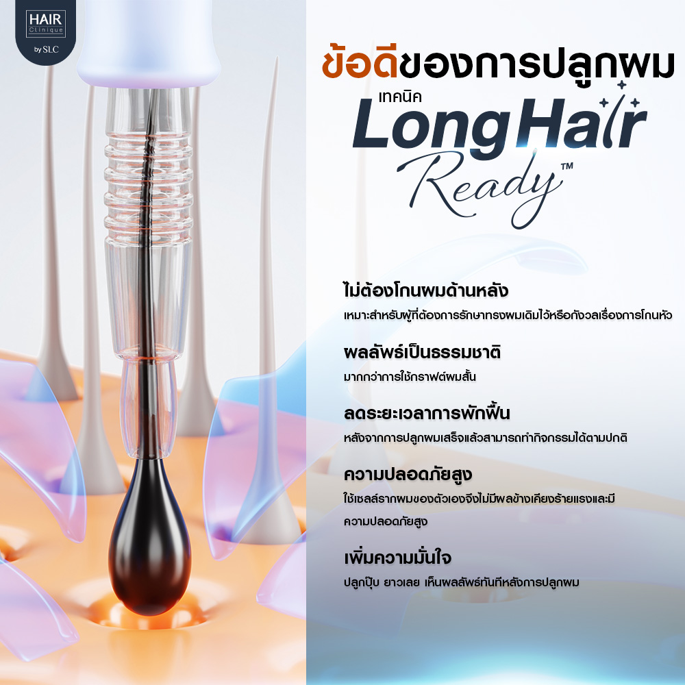 ข้อดีของการปลูกผมเทคนิค Long Hair Ready™