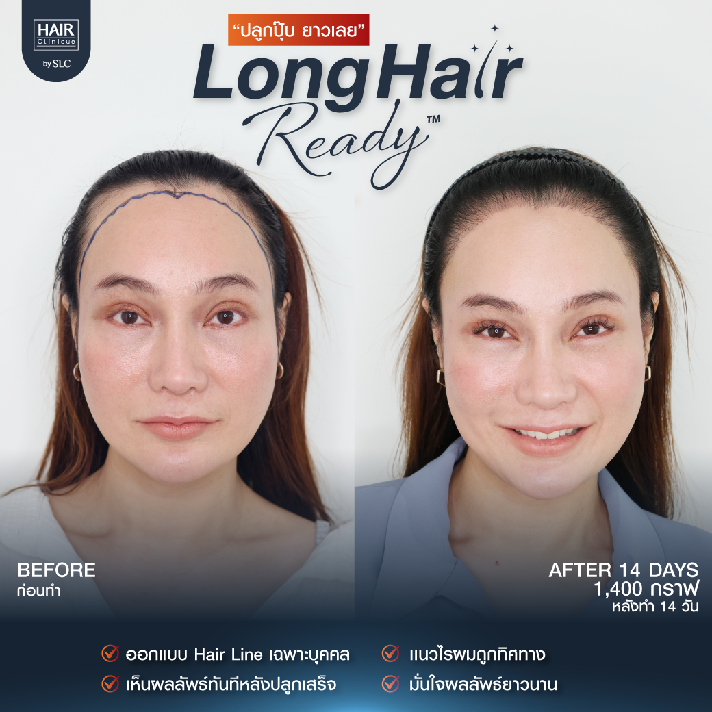 รีวิวผลการปลูกผมเทคนิค Long Hair Ready™