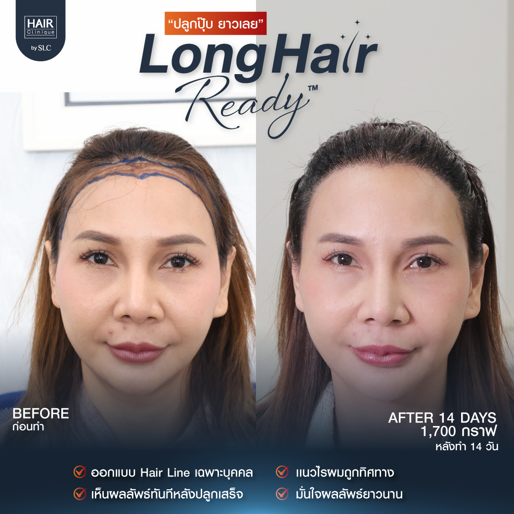 รีวิวผลการปลูกผมเทคนิค Long Hair Ready™
