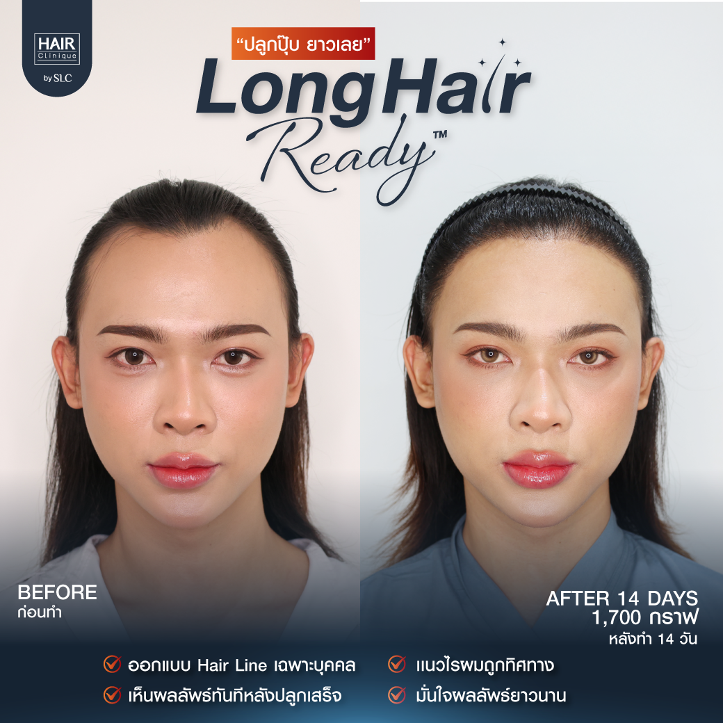 รีวิวผลการปลูกผมเทคนิค Long Hair Ready™