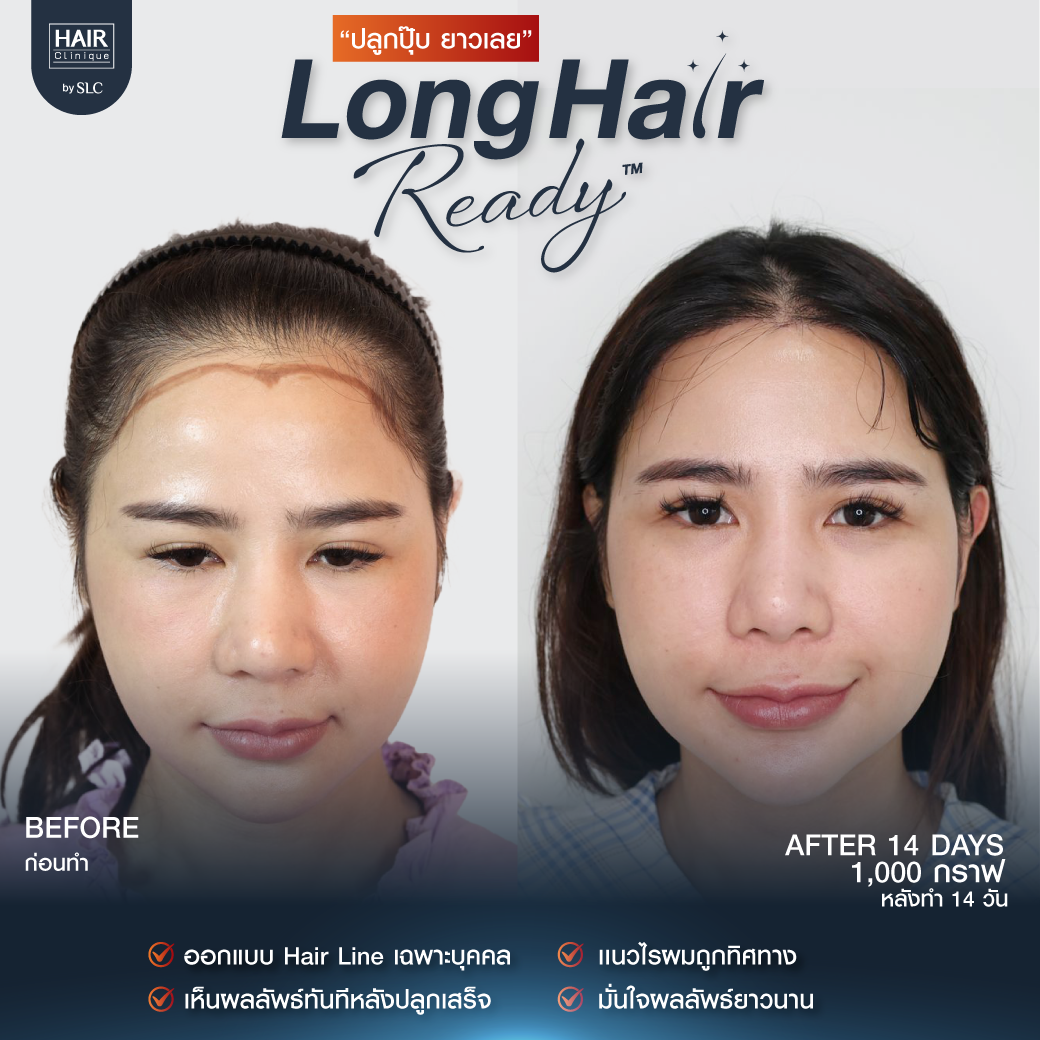 รีวิวผลการปลูกผมเทคนิค Long Hair Ready™