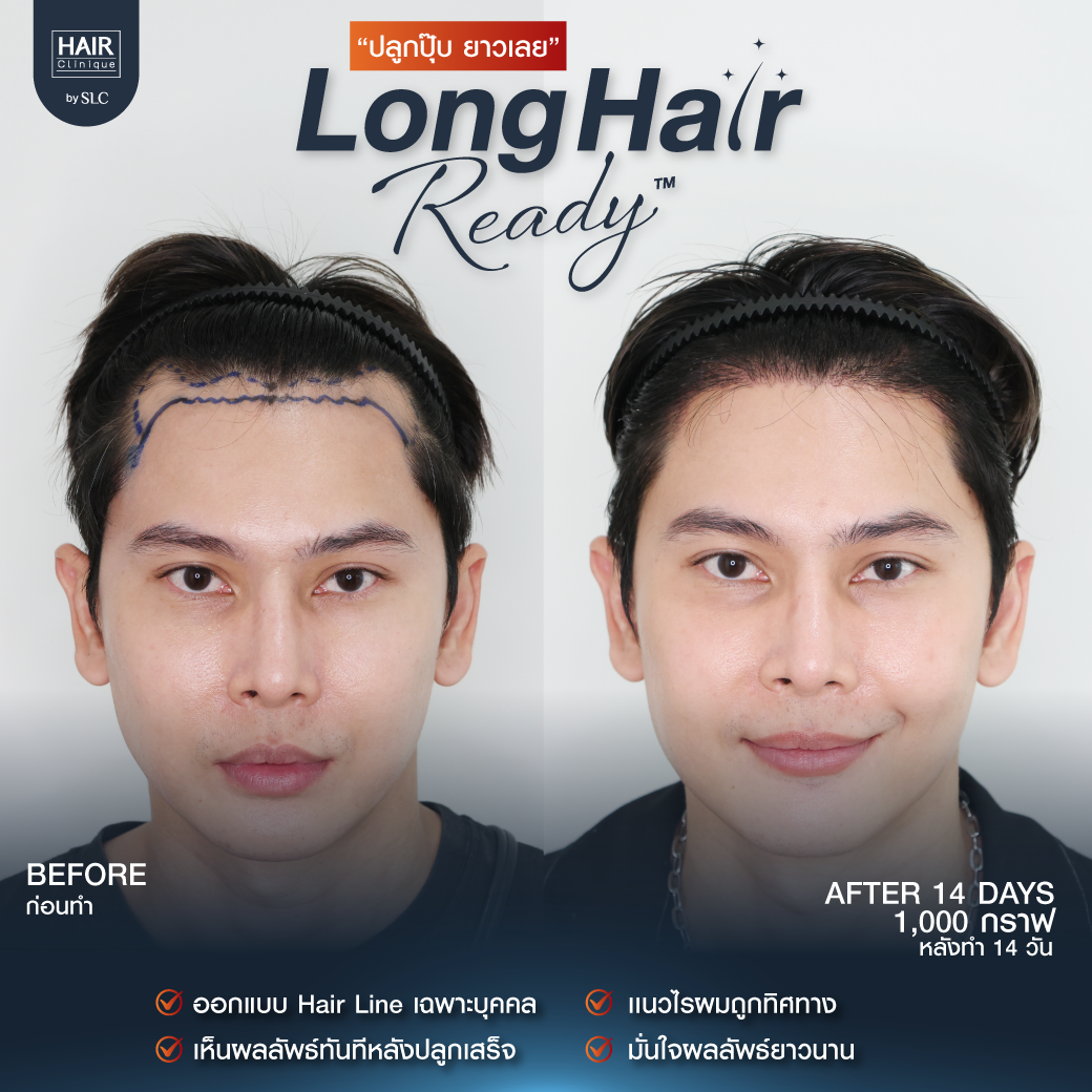 รีวิวผลการปลูกผมเทคนิค Long Hair Ready™
