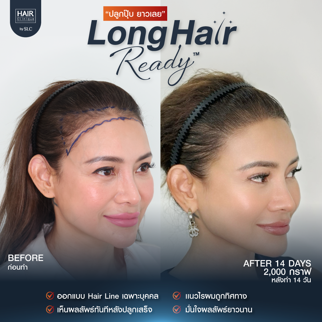 รีวิวผลการปลูกผมเทคนิค Long Hair Ready™