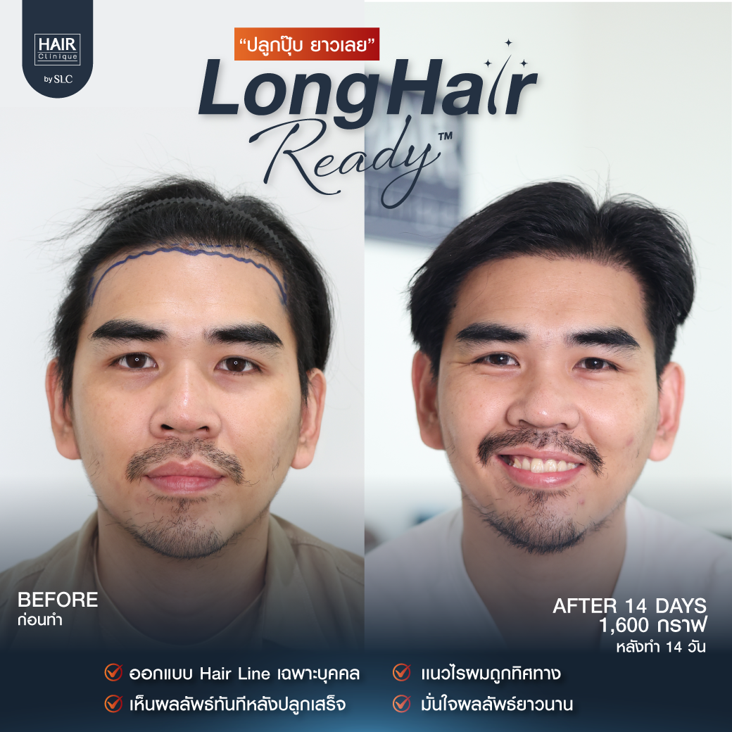 รีวิวผลการปลูกผมเทคนิค Long Hair Ready™