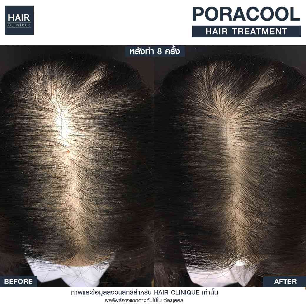 รีวิวPora Cool Hair,ลดผมร่วง,แก้ผมบาง,รักษาผมบาง