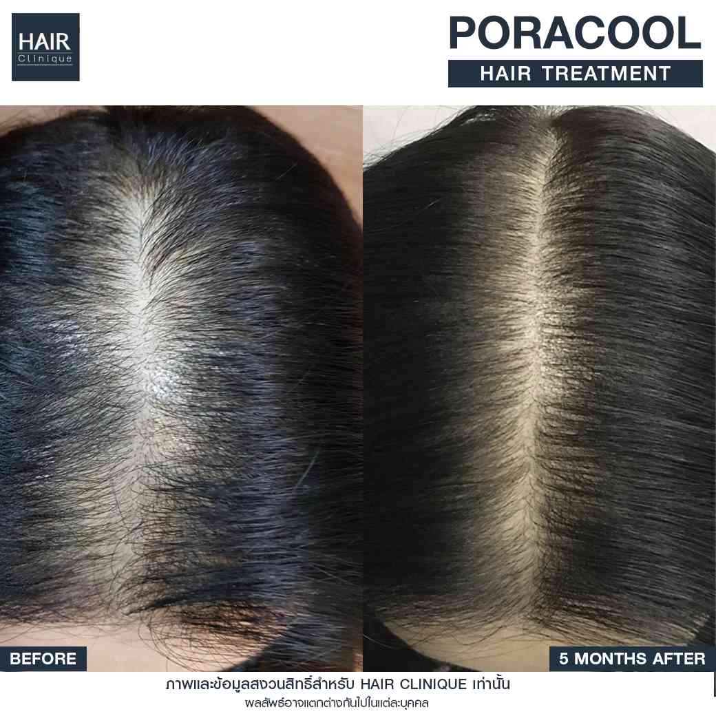 รีวิวPora Cool Hair,ลดผมร่วง,แก้ผมบาง,รักษาผมบาง