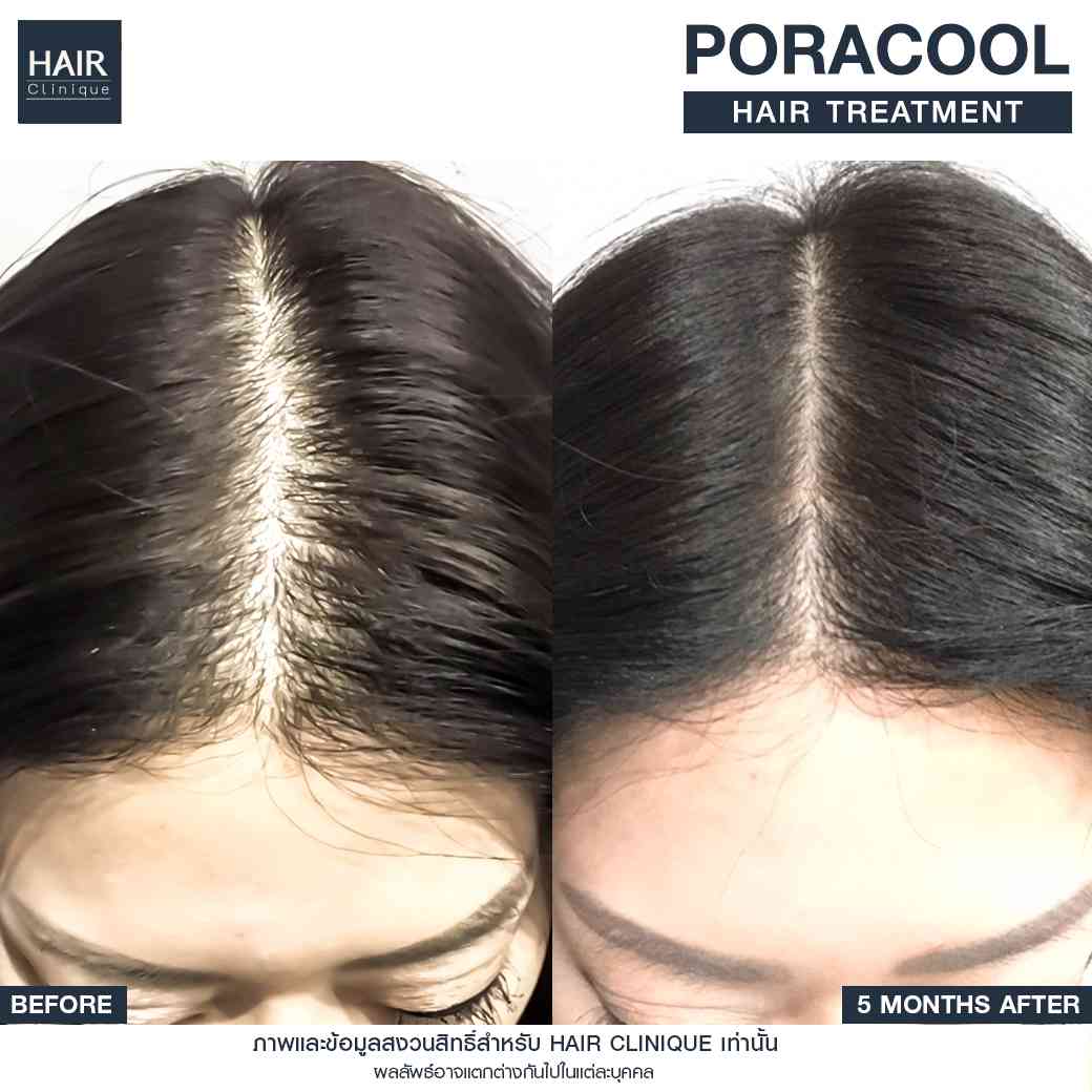 รีวิวPora Cool Hair,ลดผมร่วง,แก้ผมบาง,รักษาผมบาง