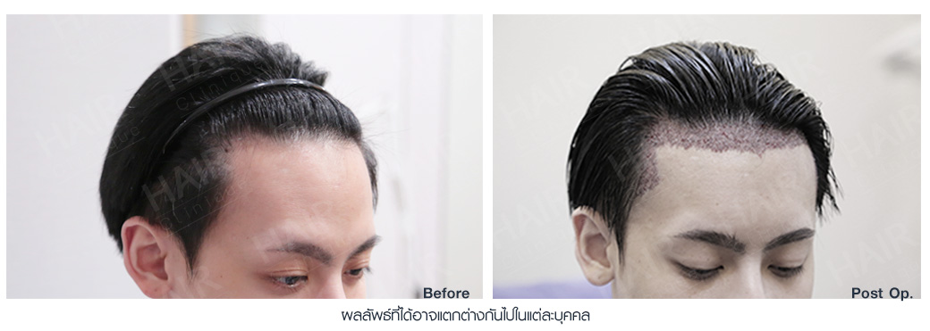 ปลูกผม,ปลููกผม fut,แพทย์อเมริกันบอร์ด,ปลูกผม Hair Clinique,รีวิวปลูกผม,รีวิวปลูกผม FUT,ผมบาง,หัวล้าน,หัวเถิก,ปลูกผมกับแพทย์อเมริกันบอร์ด,American Board of Hair Restoration Surgery,ABHRS