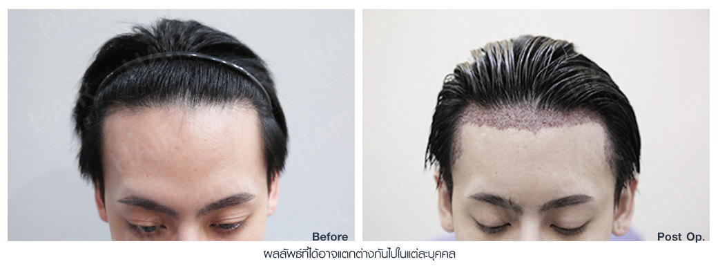 ปลูกผม,ปลููกผม fut,แพทย์อเมริกันบอร์ด,ปลูกผม Hair Clinique,รีวิวปลูกผม,รีวิวปลูกผม FUT,ผมบาง,หัวล้าน,หัวเถิก,ปลูกผมกับแพทย์อเมริกันบอร์ด,American Board of Hair Restoration Surgery,ABHRS