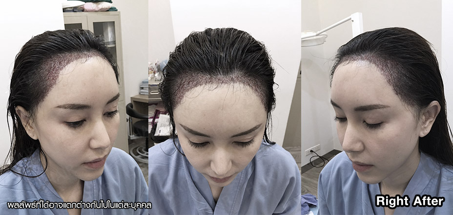 รีวิวปลูกผม-ปลูกผมที่HairClinique-ปลูกผม-ปลูกผมผู้หญิง