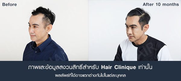 รีิวิวปลูกผม,ปลูกผม,ผมบางด้านหน้า