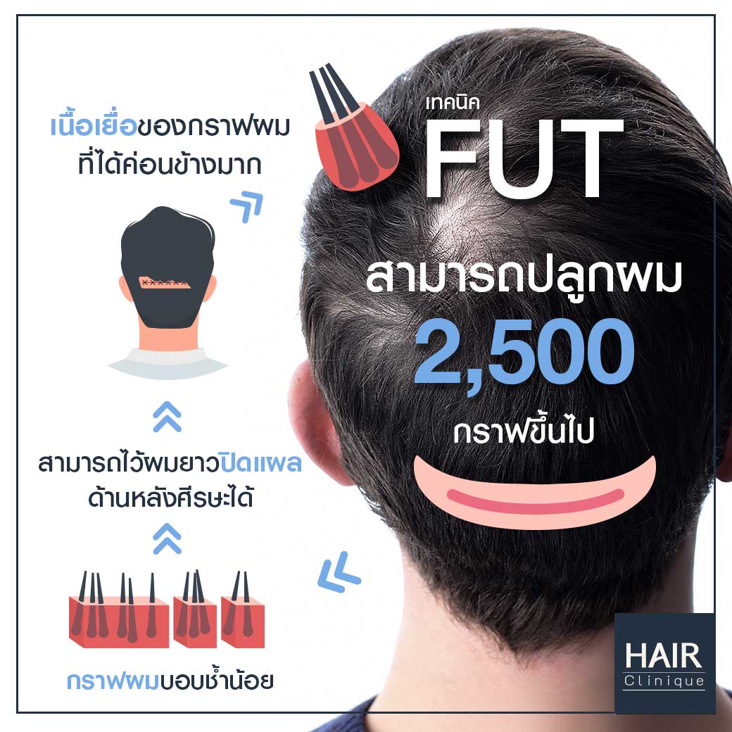 รีิวิวปลูกผม,ปลูกผม,ผมบางด้านหน้า