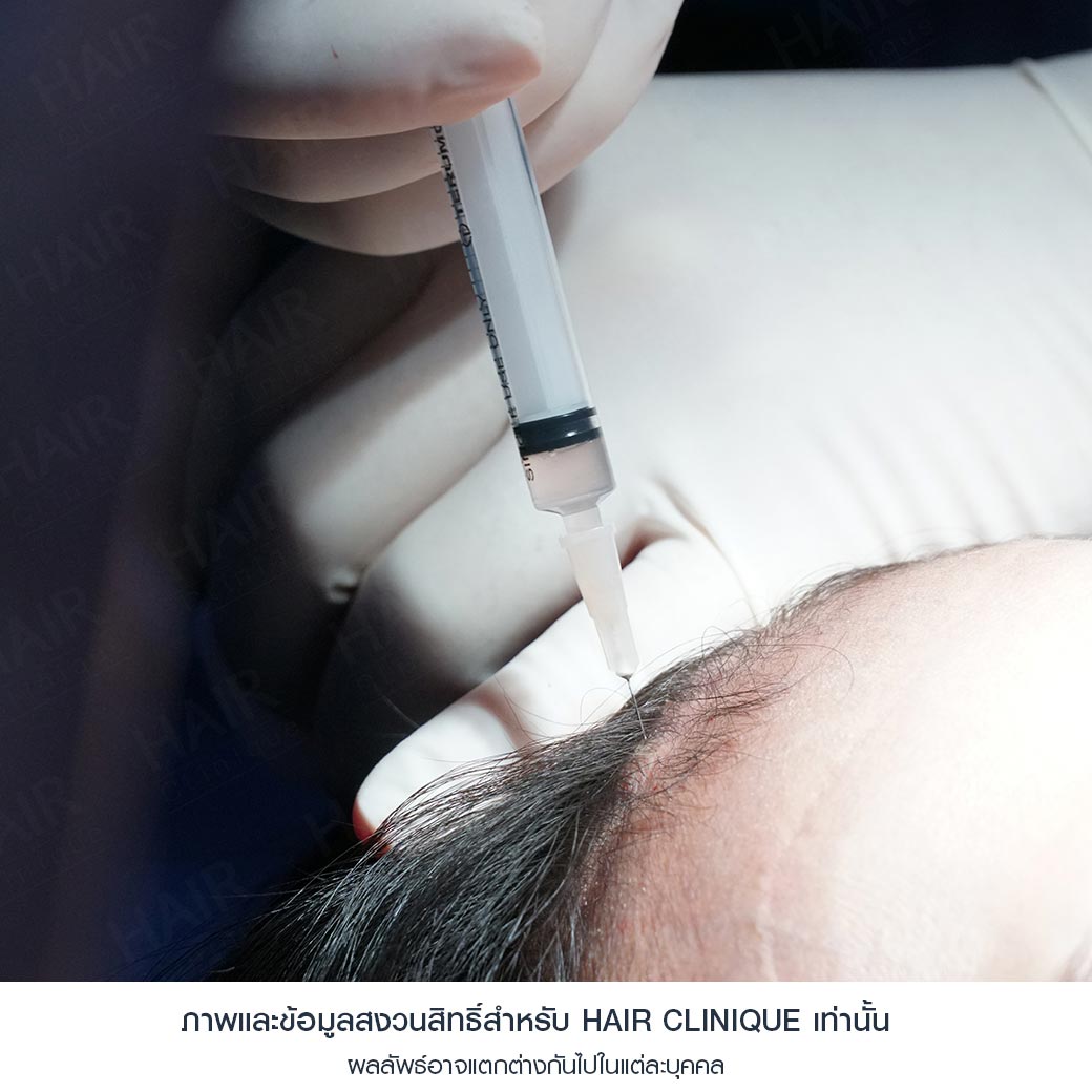 ปลูกผม Stem Cell แก้ผมร่วงหลังคลอด 