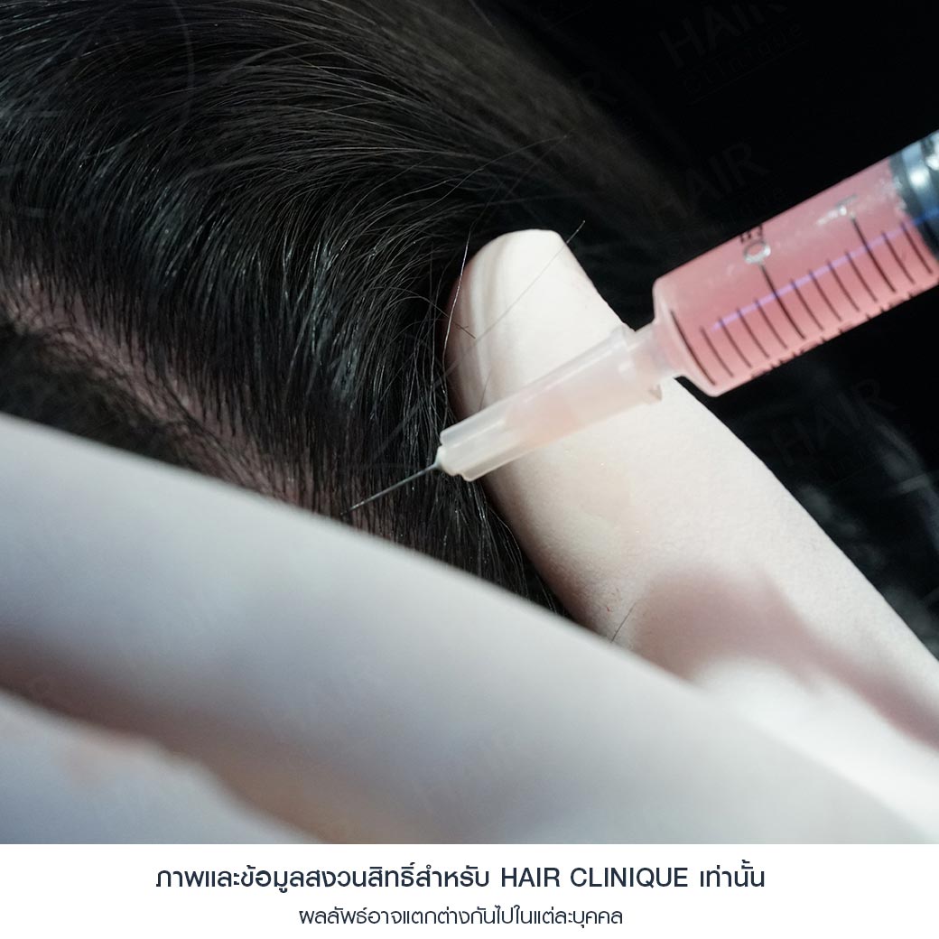 ปลูกผม Stem Cell แก้ผมร่วงหลังคลอด 