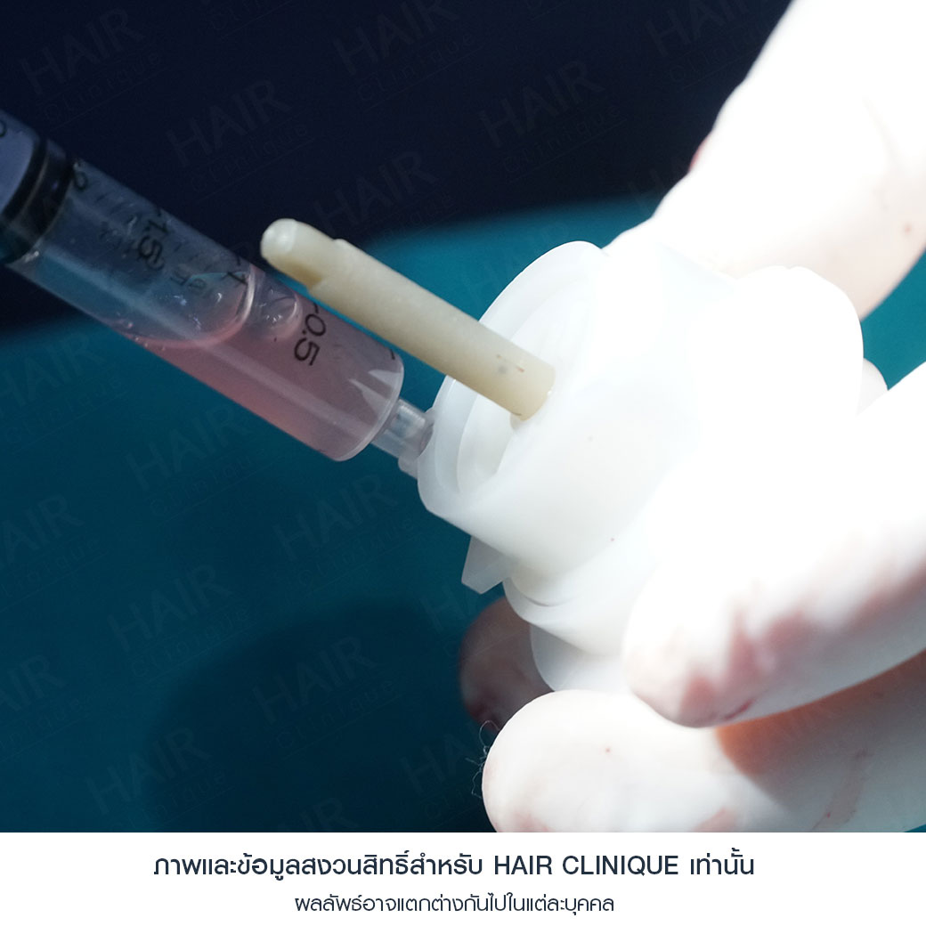 ปลูกผม Stem Cell แก้ผมร่วงหลังคลอด 