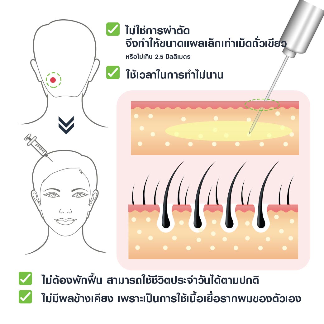 ข้อดูของการปลูกผม Stem cell