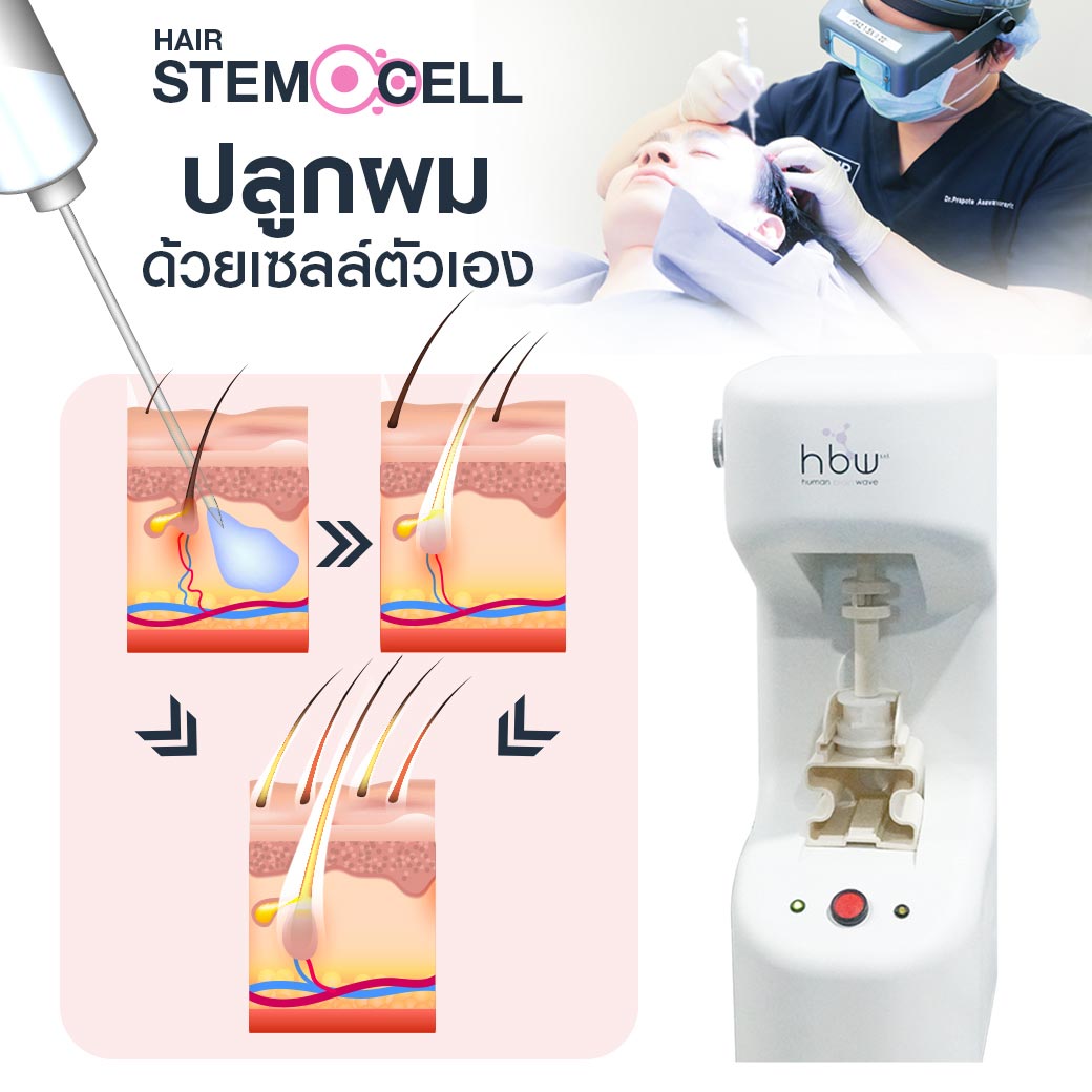 ปลูกผม Stem Cell แก้ผมร่วงหลังคลอด 