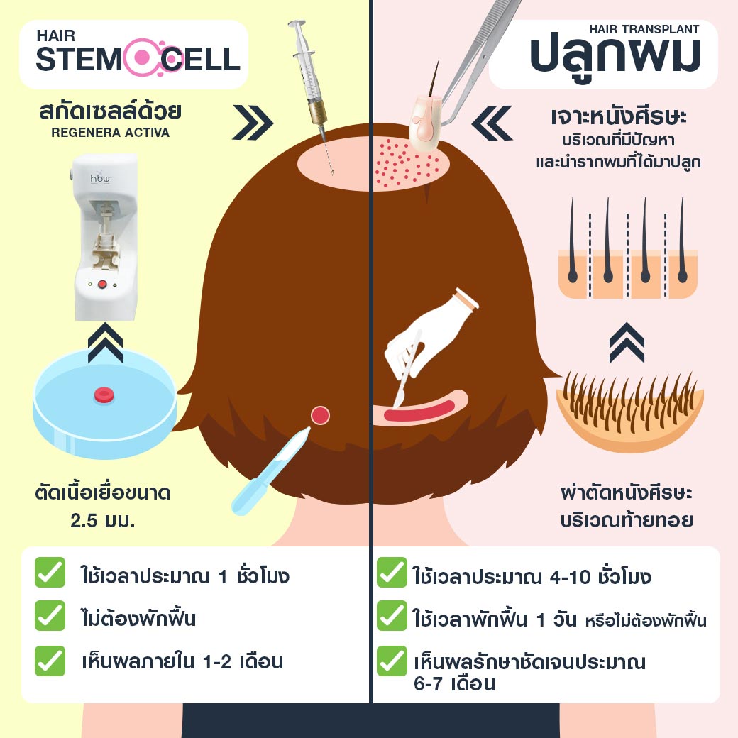 ปลูกผม Stem Cell ต่างกับ ปลูกผมย้ายเซลล์รากผม อย่างไร