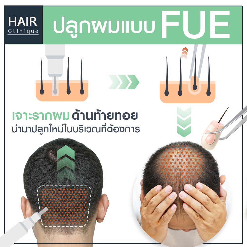 ปลูกผมFUE