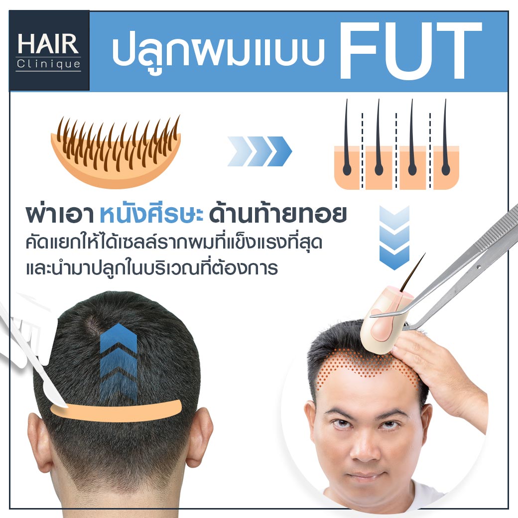 ปลูกผมFUT