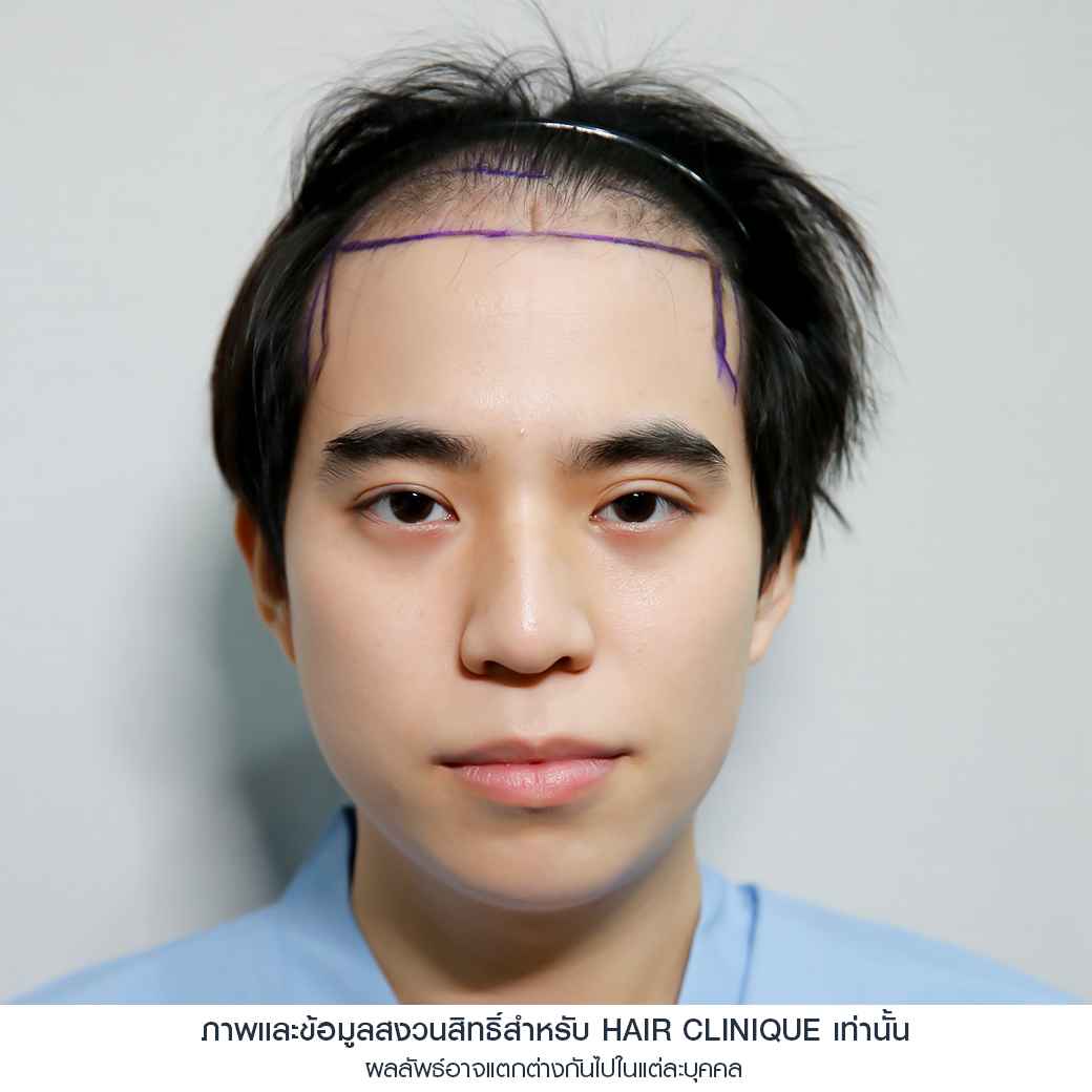 อปป้าทัชชี่-ก่อนปลูกผม-ปลูกผมfut-รีวิวปลูกผม