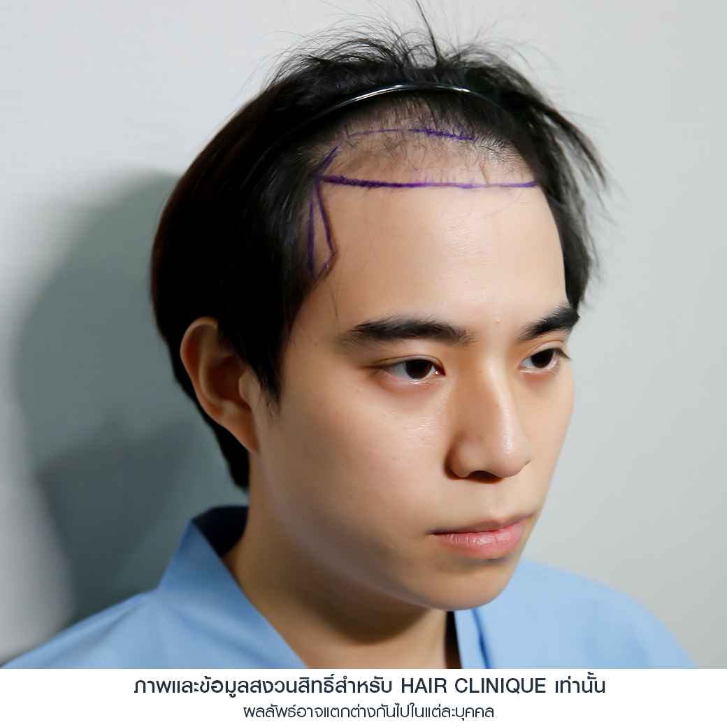 อปป้าทัชชี่-ก่อนปลูกผม-ปลูกผมfut-รีวิวปลูกผม