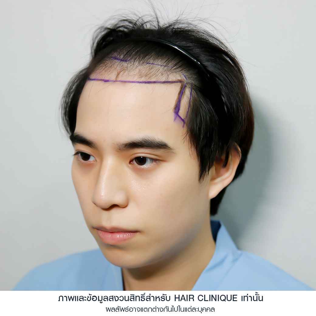 อปป้าทัชชี่-ก่อนปลูกผม-ปลูกผมfut-รีวิวปลูกผม