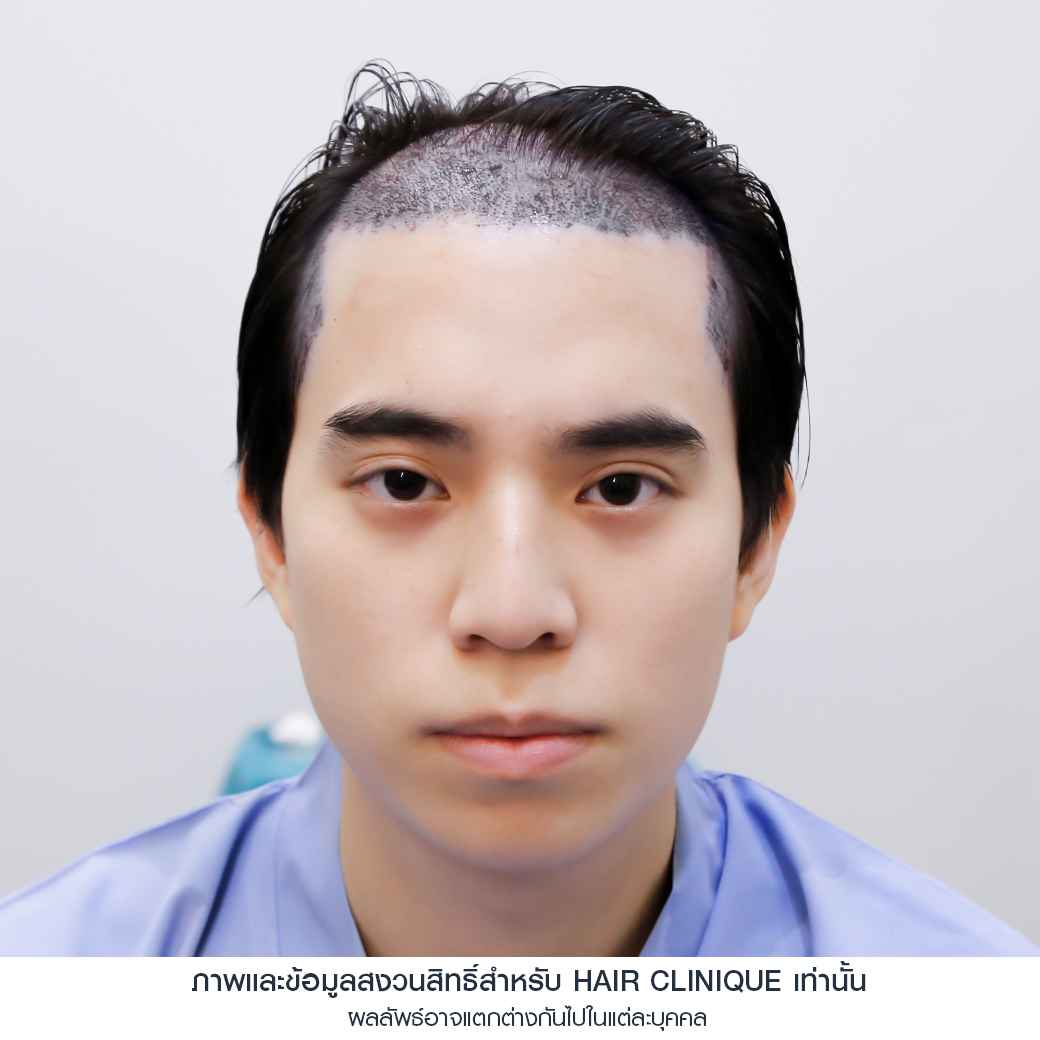 อปป้าทัชชี่-หลังปลูกผมทันที-ปลูกผมfut-รีวิวปลูกผม