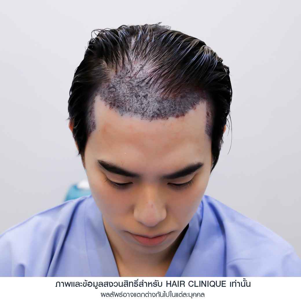 อปป้าทัชชี่-หลังปลูกผมทันที-ปลูกผมfut-รีวิวปลูกผม