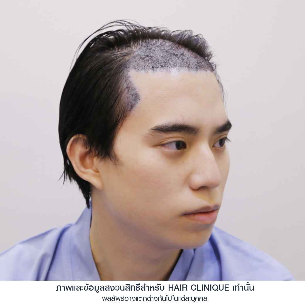 อปป้าทัชชี่-หลังปลูกผมทันที-ปลูกผมfut-รีวิวปลูกผม