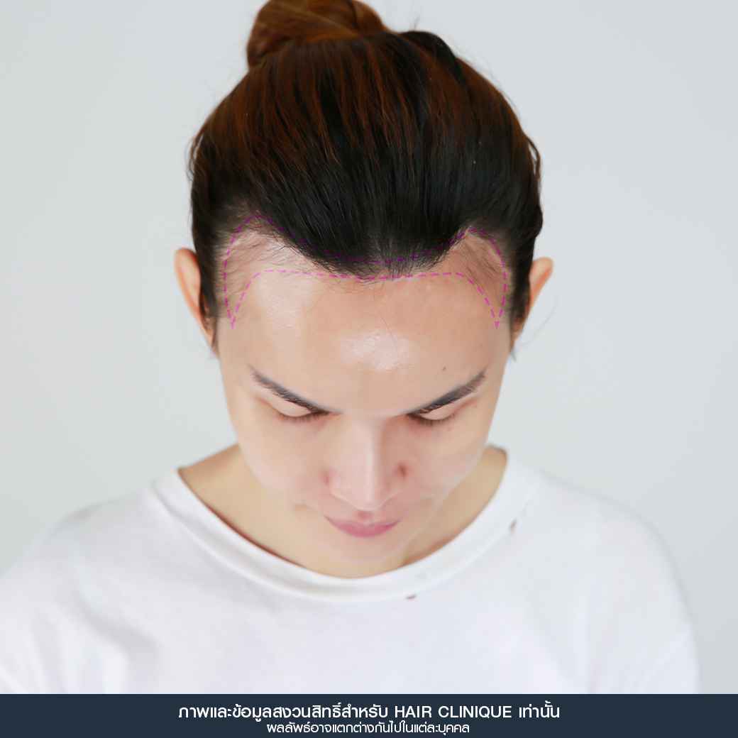 ปลูกผม,Hair Transplant,รีวิวปลูกผมผู้หญิง,รีวิวปลูกผม,หลังปลูกผม 7 วัน,หน้าผากเถิก,ปลูกผมfut