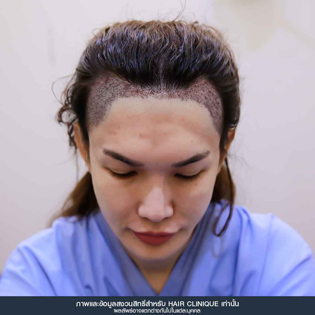 ปลูกผม,Hair Transplant,รีวิวปลูกผมผู้หญิง,รีวิวปลูกผม,หลังปลูกผมทันที,หน้าผากเถิก,ปลูกผมfut