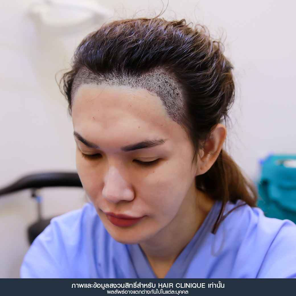 ปลูกผม,Hair Transplant,รีวิวปลูกผมผู้หญิง,รีวิวปลูกผม,หลังปลูกผมทันที,หน้าผากเถิก,ปลูกผมfut