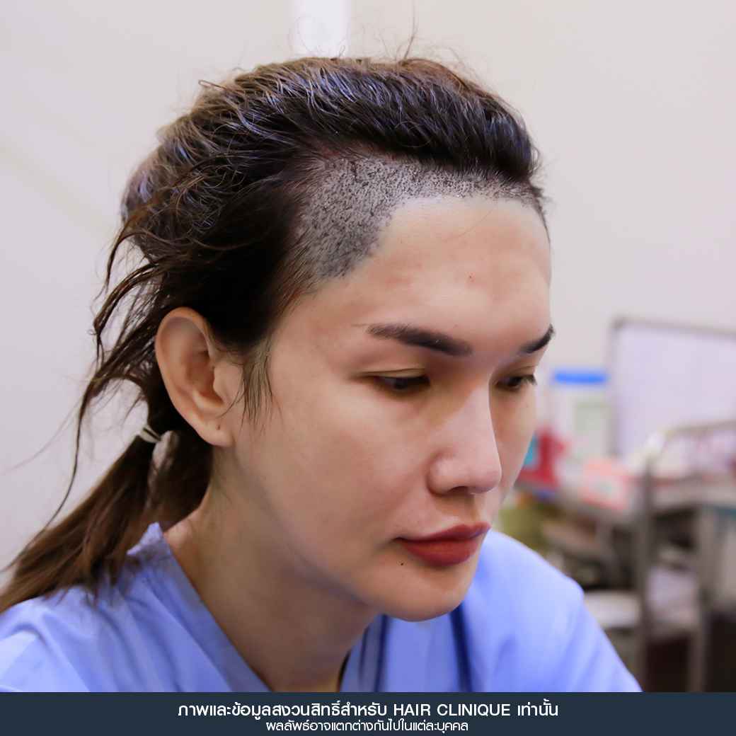 ปลูกผม,Hair Transplant,รีวิวปลูกผมผู้หญิง,รีวิวปลูกผม,หลังปลูกผมทันที,หน้าผากเถิก,ปลูกผมfut