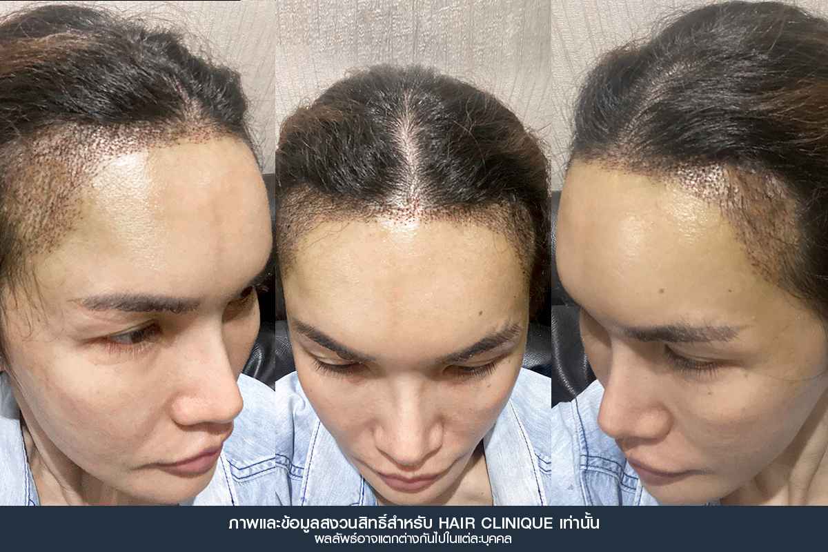 หลังปลูกผม 5 วัน