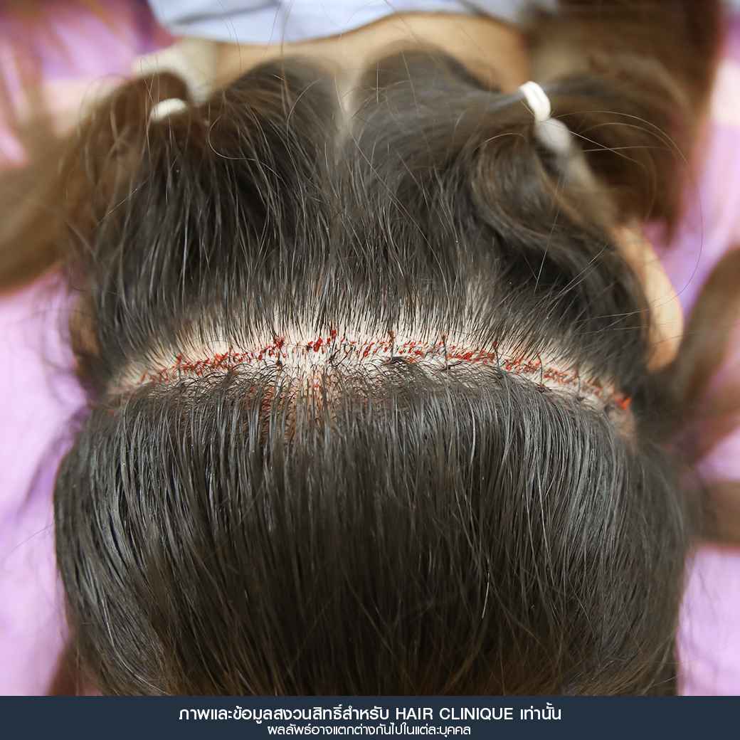 ปลูกผม,Hair Transplant,รีวิวปลูกผมผู้หญิง,รีวิวปลูกผม,หลังปลูกผม 7 วัน,หน้าผากเถิก,ปลูกผมfut