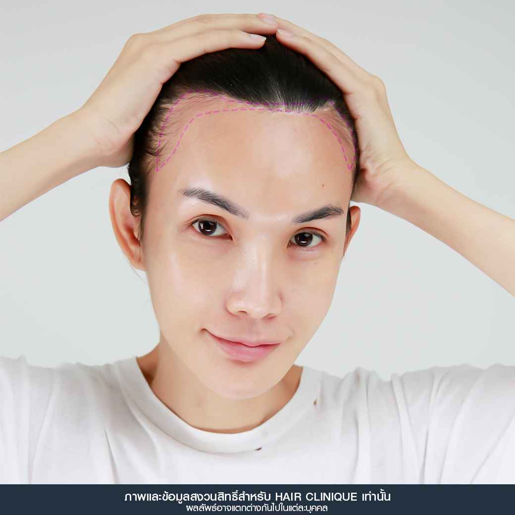 ปลูกผม,Hair Transplant,รีวิวปลูกผมผู้หญิง,รีวิวปลูกผม,หลังปลูกผม 7 วัน,หน้าผากเถิก,ปลูกผมfut