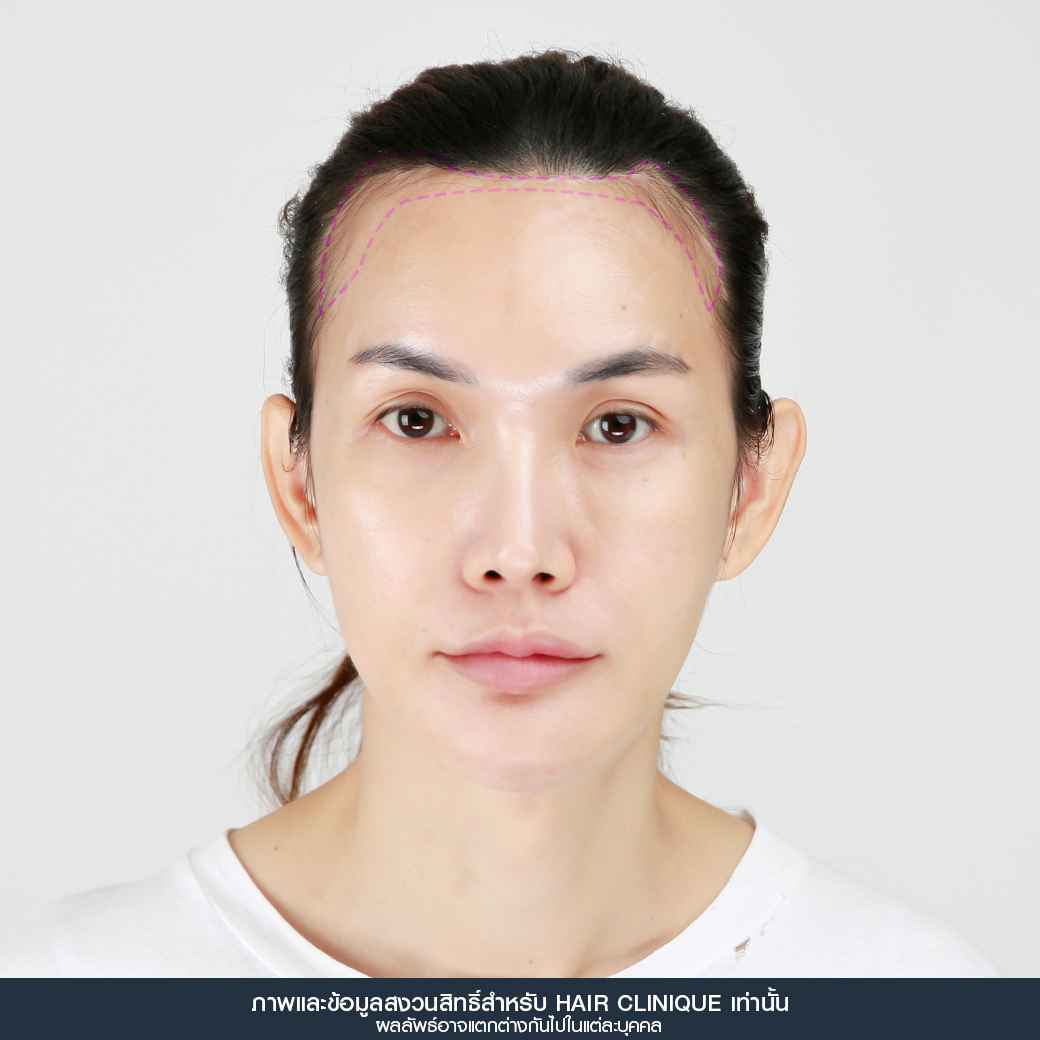 ปลูกผม,Hair Transplant,รีวิวปลูกผมผู้หญิง,รีวิวปลูกผม,หลังปลูกผม 7 วัน,หน้าผากเถิก,ปลูกผมfut