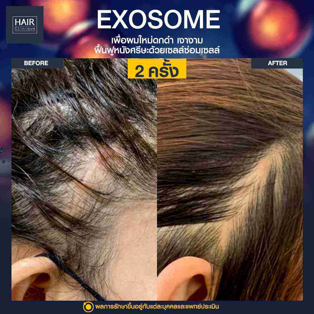 Exosome,ปลูกผมไม่ต้องผ่าตัด,ฉีด Exosome,ฉีดผม Exosome,ผมบาง,แผลเป็นบนหนังศีรษะ,รอยแผลเป็นที่หัว,ปลูกผมทับรอยแผลเป็น,รีวิวExosome