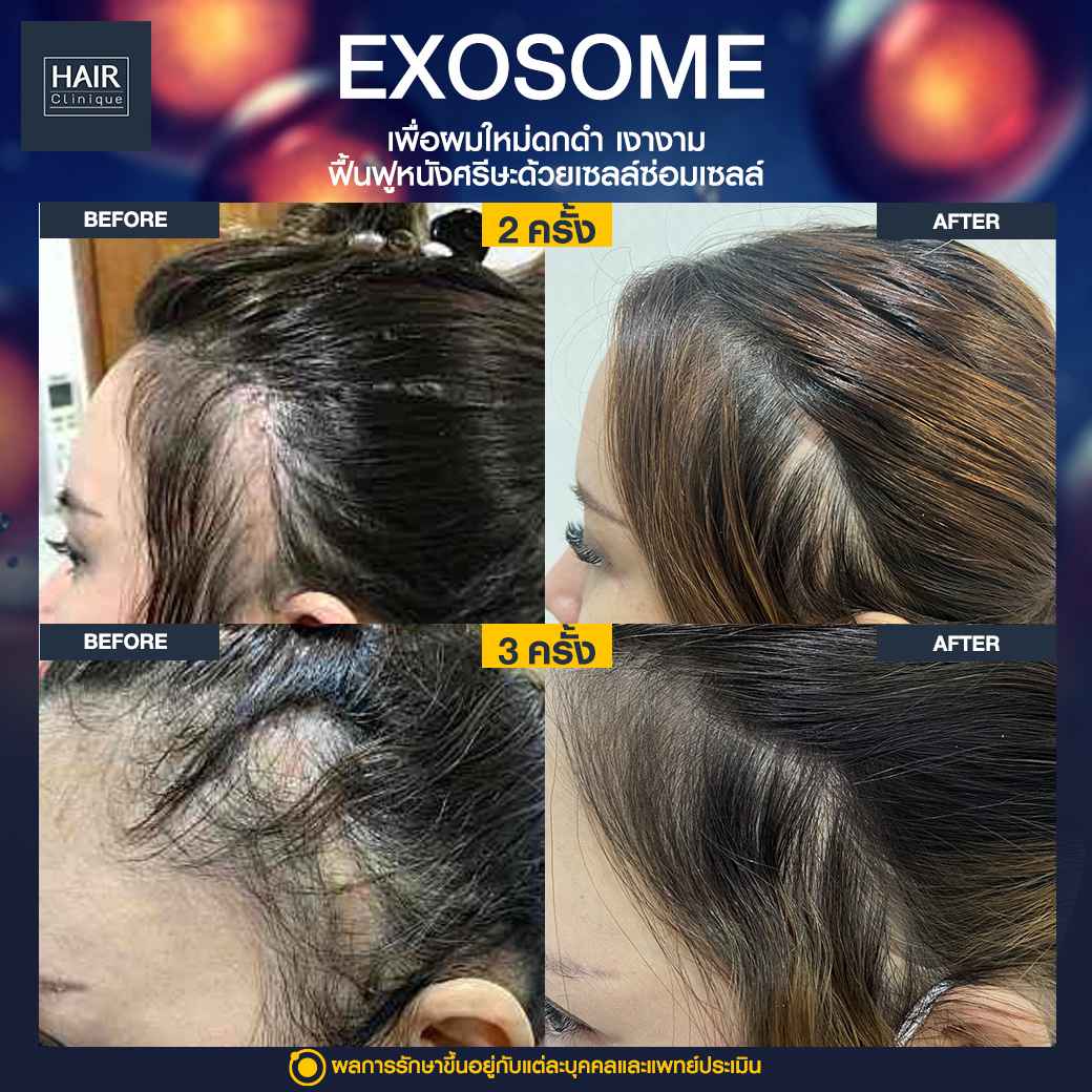 ปลูกผม,หัวเถิก,รีวิวปลูกผม,ปลูกผม fue,หัวเถิก ผู้ชาย,ปลูกผม fut,หัวเถิก ทรงผม ผู้หญิง,Exosome Hair Signature Formula™,ฉีด Exosome Hair SLC,Exosome,รีวิวExosomeslc