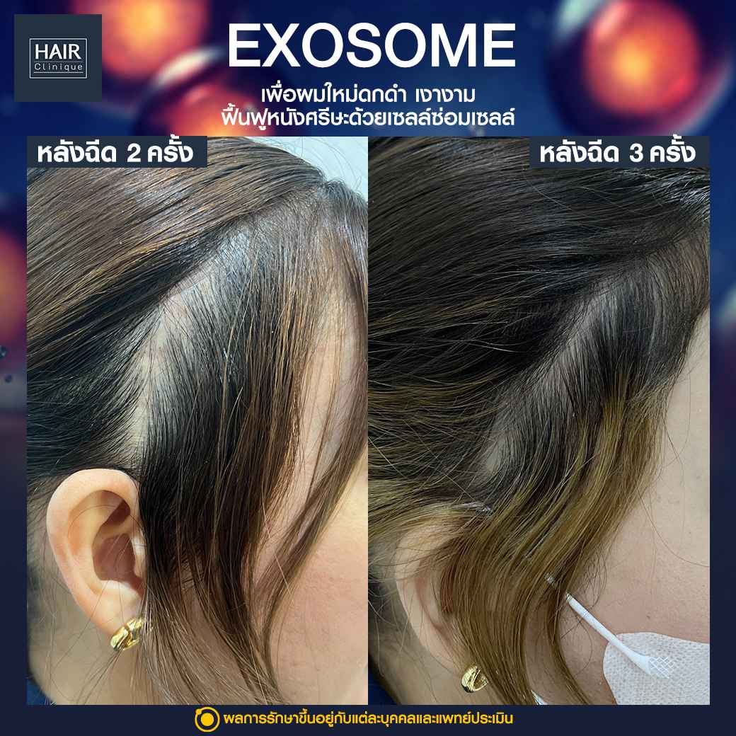 Exosome,ปลูกผมไม่ต้องผ่าตัด,ฉีด Exosome,ฉีดผม Exosome,ผมบาง,แผลเป็นบนหนังศีรษะ,รอยแผลเป็นที่หัว,ปลูกผมทับรอยแผลเป็น,รีวิวExosome