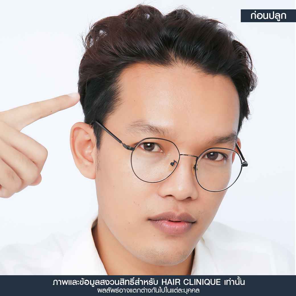 ก่อนปลูกผม,ปลูกผม,ปลูกผม fue,ปลูกผม 2000 กราฟ,รีวิวปลูกผม,ปลูกผมHairClinique,ปลูกผม SLC,รีวิวปลูกผม Hair Clinique